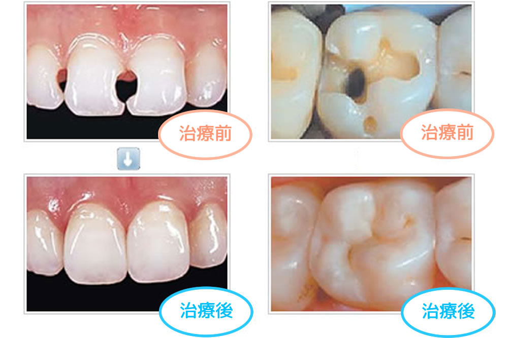 つめ物・かぶせ物(審美歯科)さいたま市緑区｜あきデンタル 浦和美園