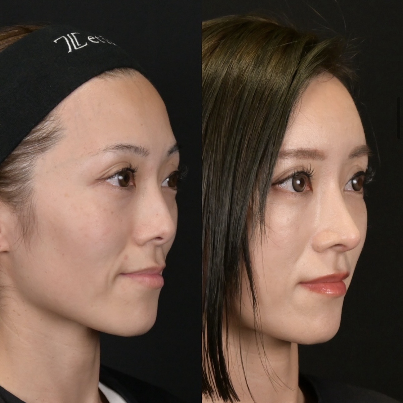 鼻整形 - ゼティスビューティークリニック｜鼻整形・鼻形成、美肌専門