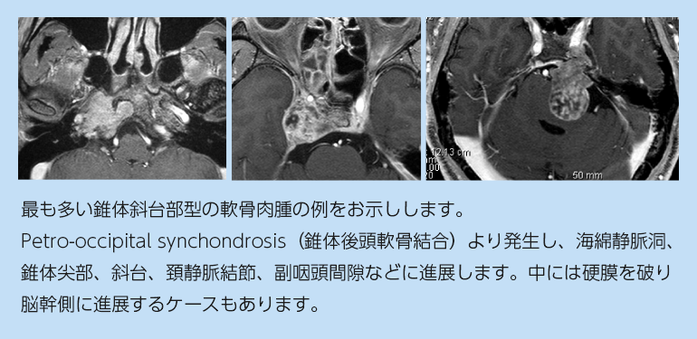 頭蓋底軟骨肉腫 | 脳神経外科医 長谷川洋敬 公式サイト