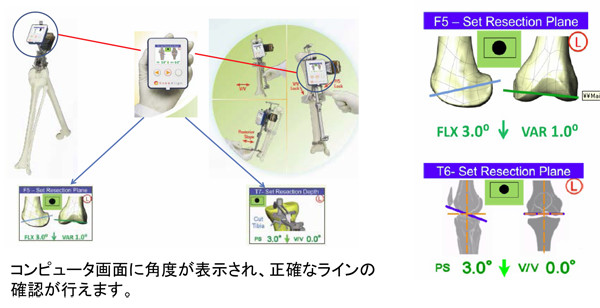 人工関節置換術(下肢)│当院の治療の特色│社会医療法人玄真堂 川嶌