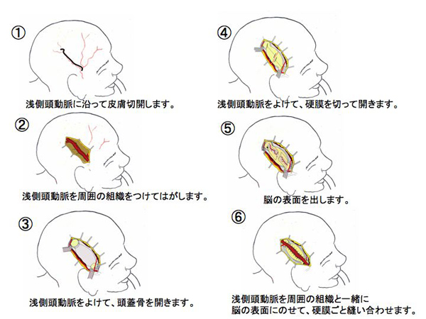 もやもや病 | KOMPAS – 慶應義塾大学病院 医療・健康情報サイト