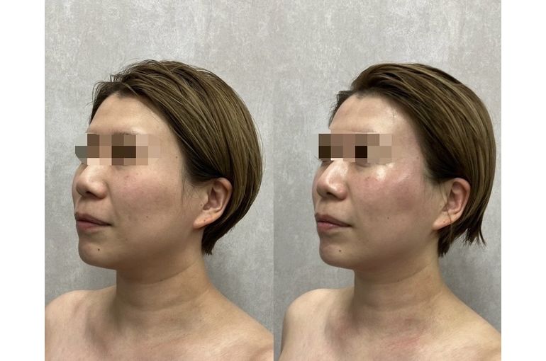 リアボーテ 大阪】ディゾセラム エンマ ハーブトリートメント効果