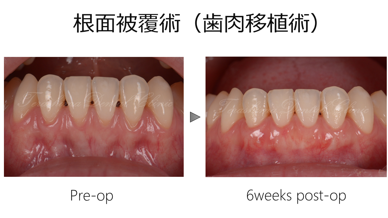 歯肉退縮への根面被覆術~ブラックトライアングルも少し改善したケース