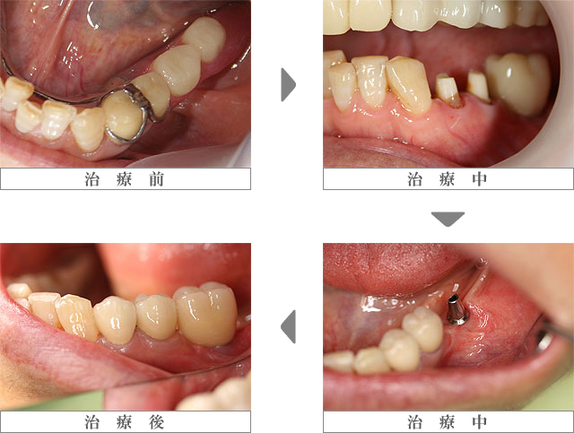 審美歯科 もり歯科医院 日進市の歯医者