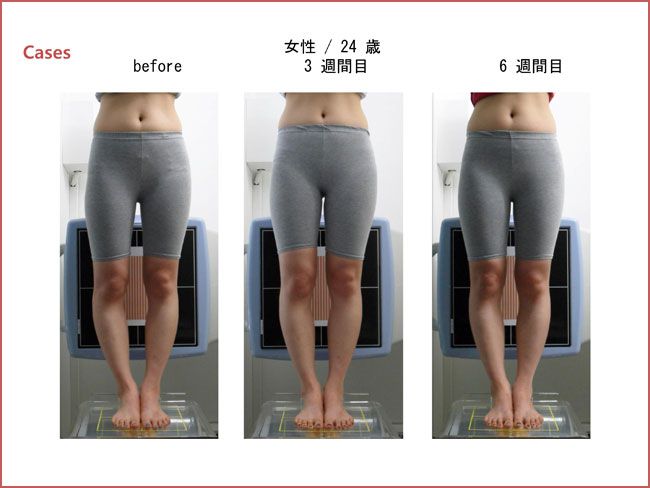スタイレックス（O脚・X脚改善） | 姫路なかむら整骨院